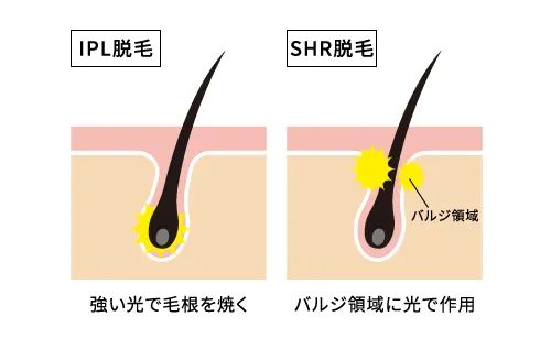 画像：脱毛効果